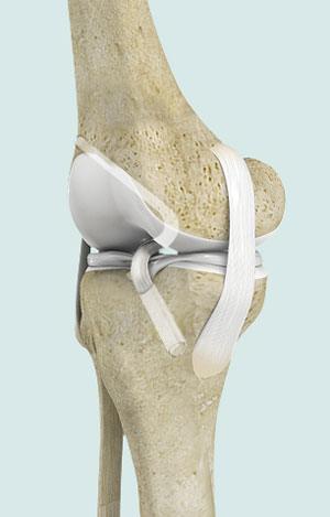  Anterior Cruciate Ligament ACL Reconstruction 